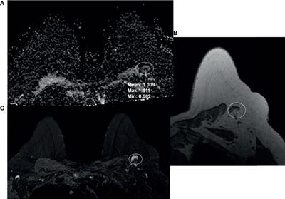 Differentiation Between Benign and Metastatic Breast Lymph Nodes Using Apparent Diffusion Coefficients